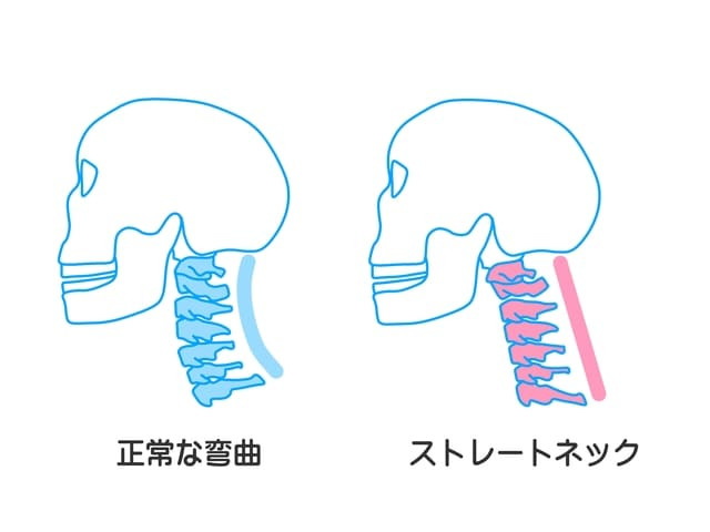 明石　朝霧整体院　ストレートネック改善